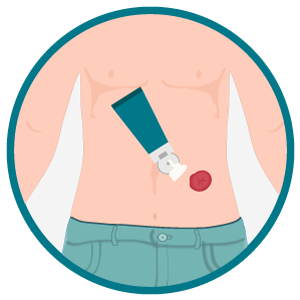 Ilustração do abdômen de pessoa ostomizada enquanto um tubo aplica pasta/barreira protetora ao redor do estoma vermelho.