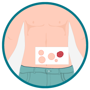 Ilustração do abdômen com um gabarito de marcação que mostra possíveis posições de estomia; um dos círculos está preenchido em vermelho indicando o local escolhido para o estoma.