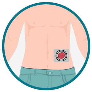 Ilustração do abdômen de pessoa ostomizada com placa adesiva fixada ao redor do estoma.