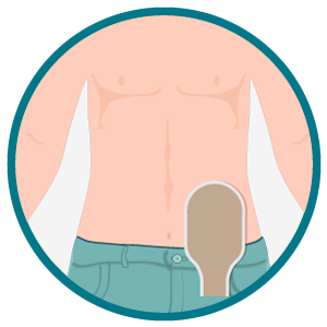 Ilustração do abdômen de pessoa ostomizada com bolsa coletora opaca fixada sobre o estoma.
