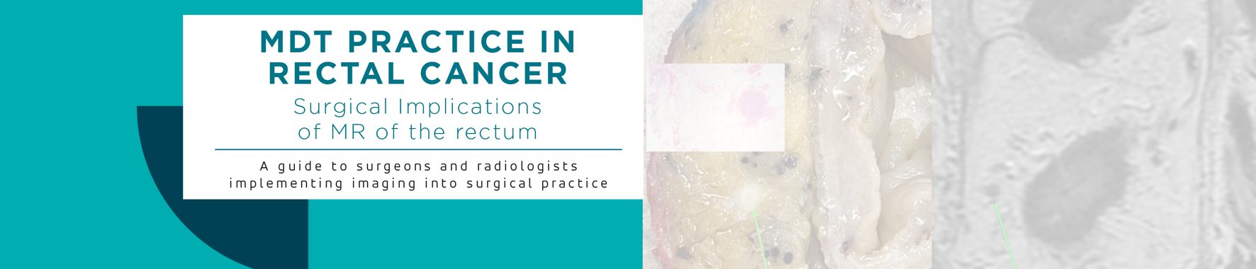 Surgical Implications of MR of the rectum