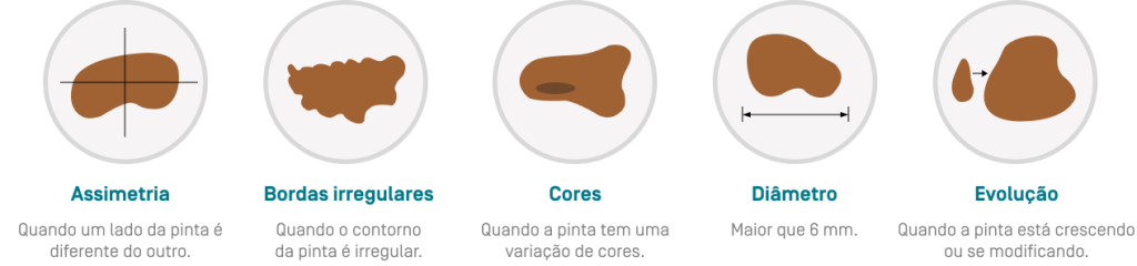 Cãncer de Pele: Sintomas do melanoma