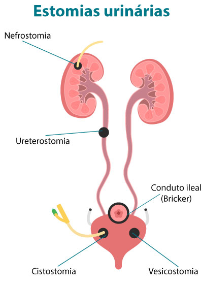 Estomias urinárias: nefrostomia, ureterostomia, cistostomia, vesicostomia e conduto ileal (Bricker). Ilustração do sistema urinário com indicação dos principais tipos de estomias: nefrostomia nos rins, ureterostomia nos ureteres, cistostomia e vesicostomia na bexiga, além do conduto ileal (Bricker).