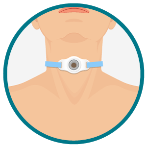 Traqueostomia: visão externa do estoma e dispositivo de fixação. Ilustração frontal do pescoço com um estoma de traqueostomia protegido por flange e cinta de sustentação azul.