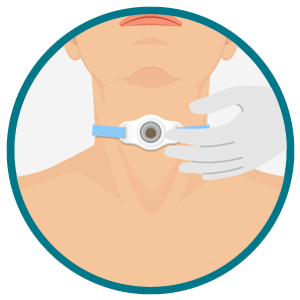 Cuidado do estoma de traqueostomia: mão enluvada avaliando e higienizando o local. Ilustração frontal do pescoço com estoma de traqueostomia; mão enluvada toca suavemente o dispositivo, indicando cuidado ou limpeza.