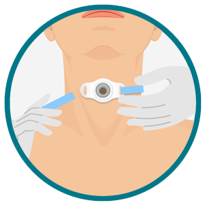 Troca da faixa de fixação da traqueostomia: ajuste seguro do dispositivo no pescoço. Ilustração frontal do pescoço com estoma de traqueostomia enquanto mãos enluvadas substituem a faixa de fixação azul.