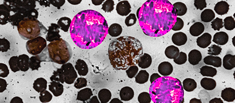 Células sanguíneas em exame laboratorial de síndromes mieloproliferativas Imagem microscópica de células sanguíneas com destaque para células de coloração rosa, ilustrando uma análise laboratorial de síndromes mieloproliferativas.