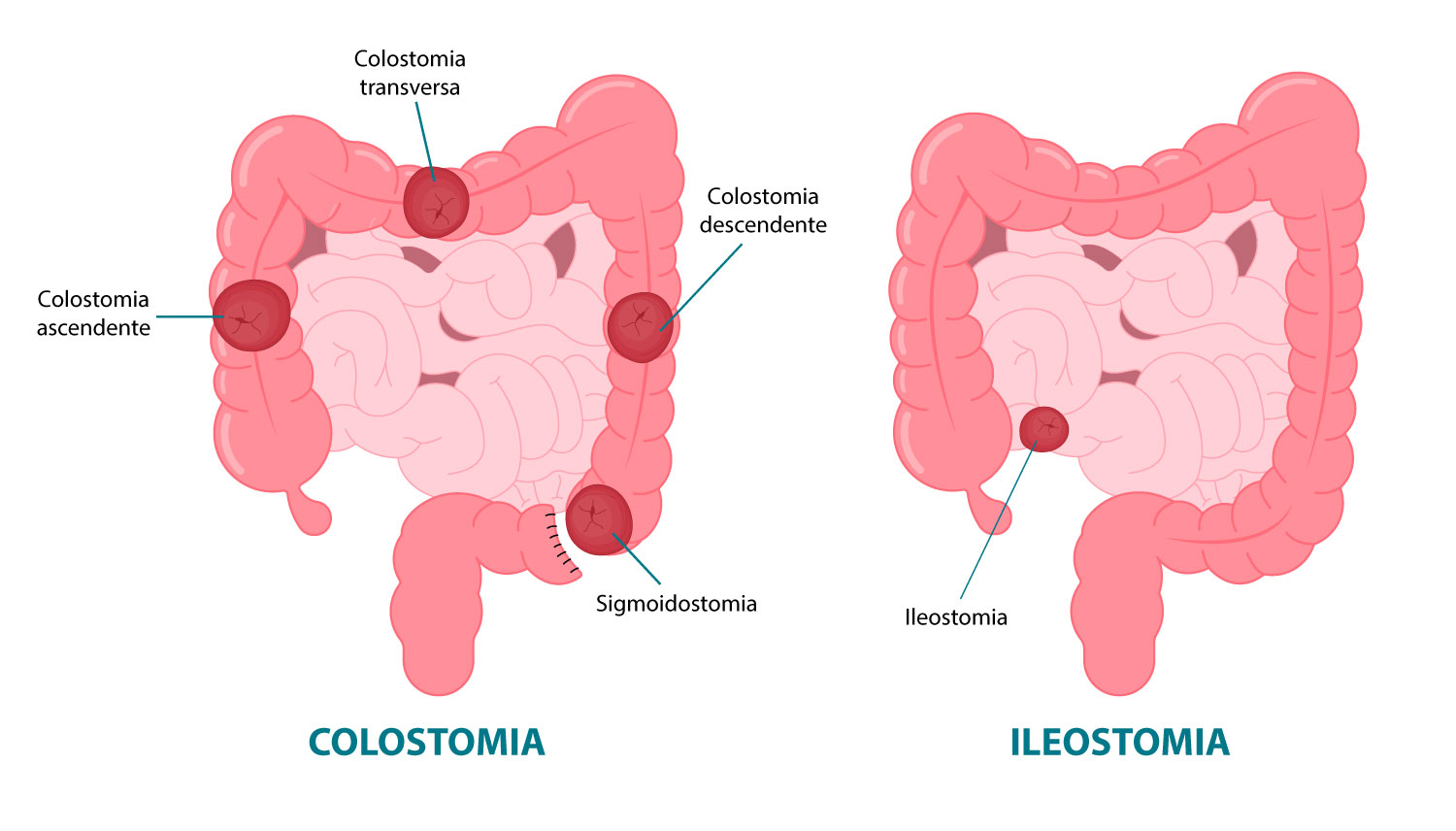 Colostomia × Ileostomia: posições dos estomas no sistema digestivo.