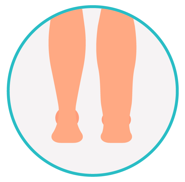 Inchaço nas pernas (edema) Ilustração de duas pernas com tornozelos visivelmente inchados, sugerindo edema nos membros inferiores